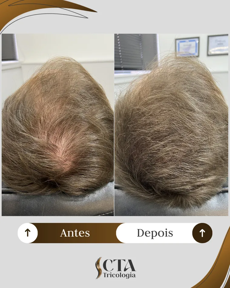 Resultado paciente 1 - Antes e Depois CTA Tricologia