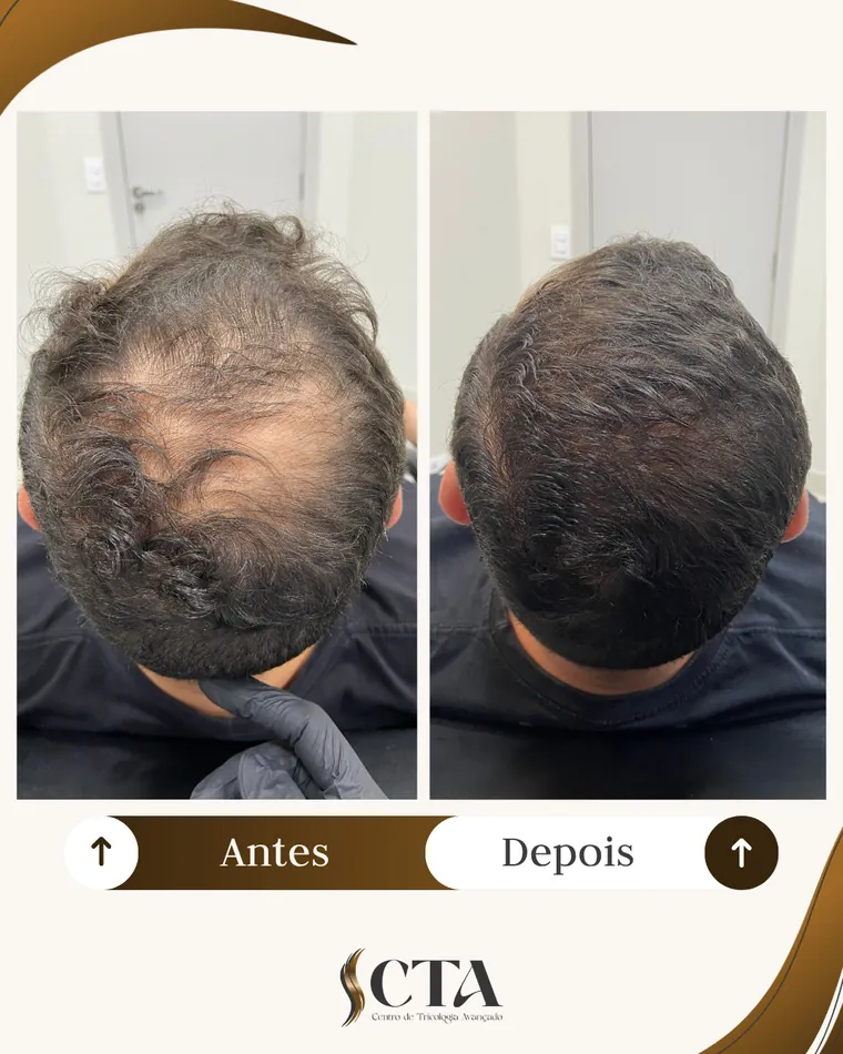 Resultado paciente 2 - Antes e Depois CTA Tricologia