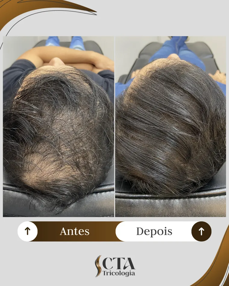 Resultado paciente 3 - Antes e Depois CTA Tricologia