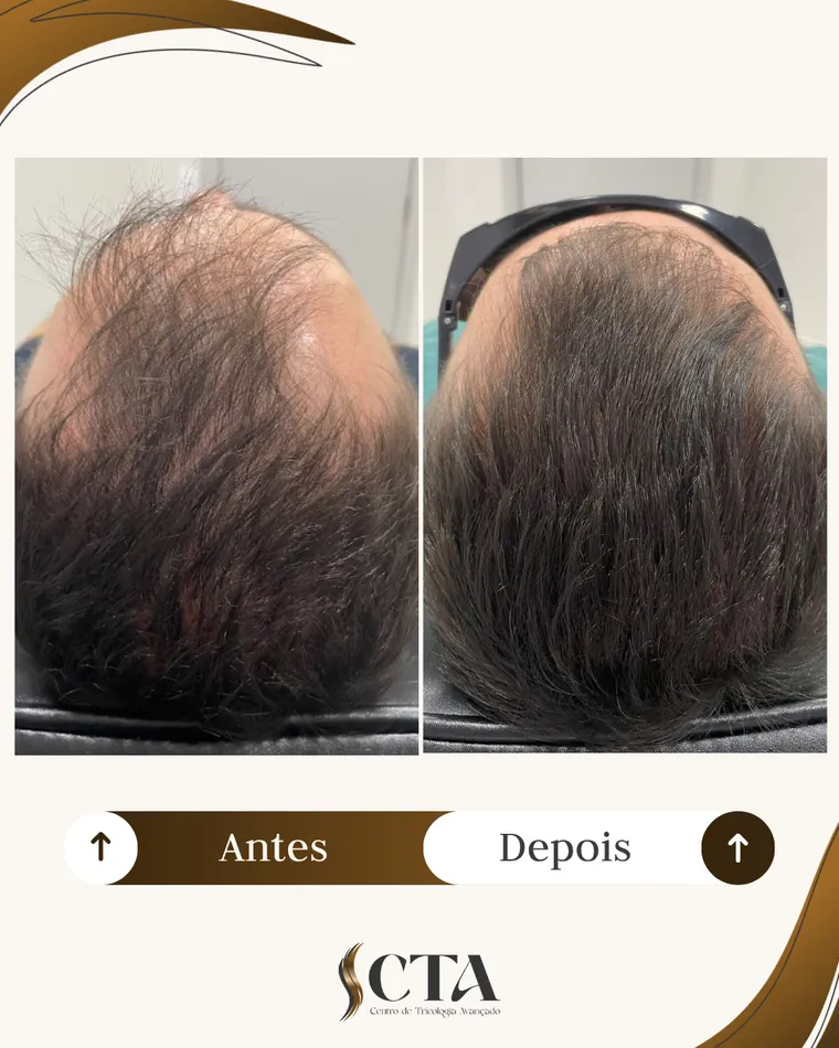 Resultado paciente 4 - Antes e Depois CTA Tricologia